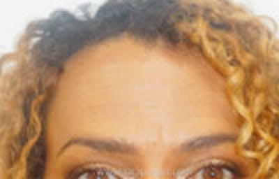 Browlift / Fox Eye Lift Before & After Gallery - Patient 308291 - Image 2