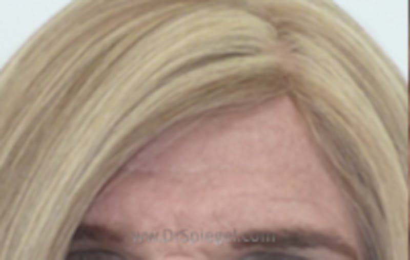 Browlift / Fox Eye Lift Before & After Gallery - Patient 235042 - Image 1