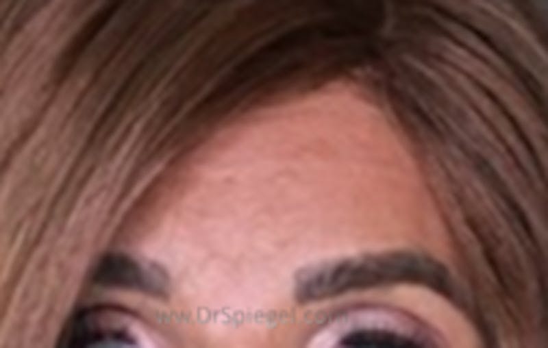 Browlift / Fox Eye Lift Before & After Gallery - Patient 235042 - Image 2