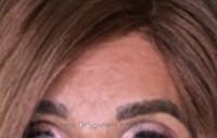 Brow Lift / Fox Eye Lift Before & After Gallery - Patient 235042 - Image 2