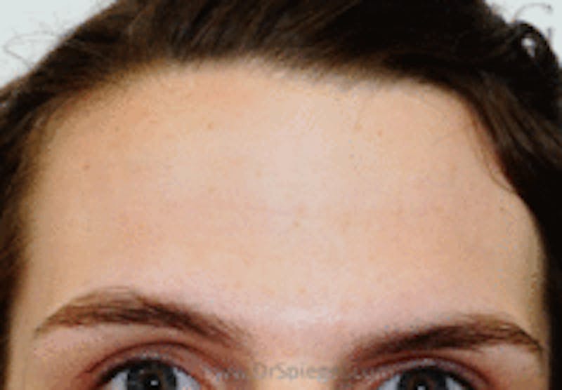 Browlift / Fox Eye Lift Before & After Gallery - Patient 676795 - Image 1