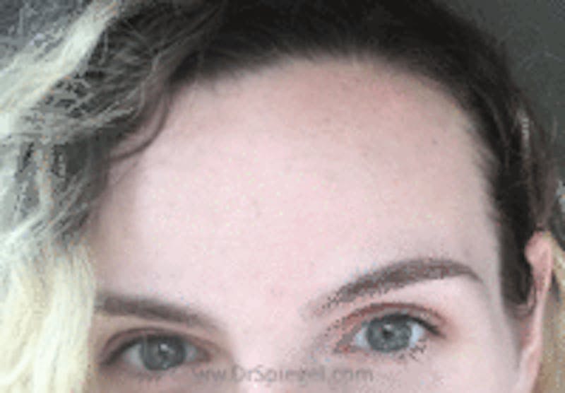 Browlift / Fox Eye Lift Before & After Gallery - Patient 676795 - Image 2