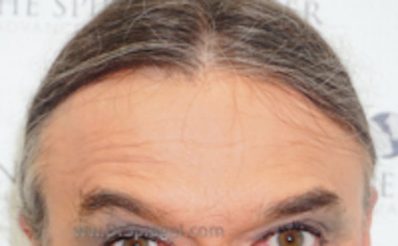 Browlift / Fox Eye Lift Before & After Gallery - Patient 290134 - Image 1