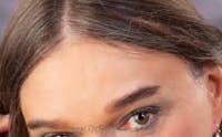 Brow Lift / Fox Eye Lift Before & After Gallery - Patient 290134 - Image 2