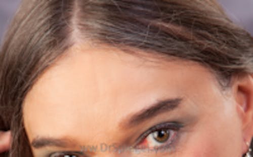 Brow Lift / Fox Eye Lift Before & After Gallery - Patient 290134 - Image 2