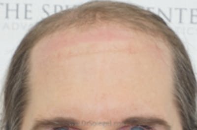 Browlift / Fox Eye Lift Before & After Gallery - Patient 363887 - Image 1