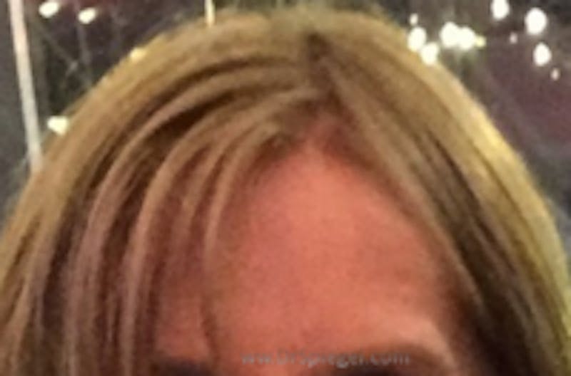 Browlift / Fox Eye Lift Before & After Gallery - Patient 363887 - Image 2