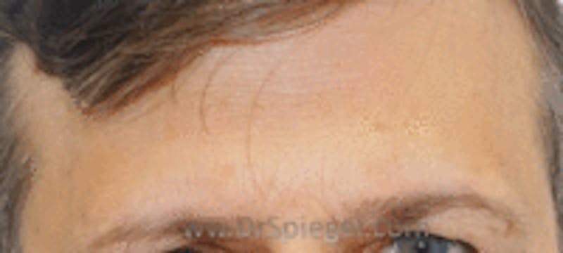 Browlift / Fox Eye Lift Before & After Gallery - Patient 425402 - Image 1