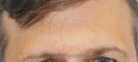 Brow Lift / Fox Eye Lift Before & After Gallery - Patient 425402 - Image 1