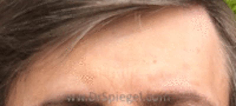 Browlift / Fox Eye Lift Before & After Gallery - Patient 425402 - Image 2