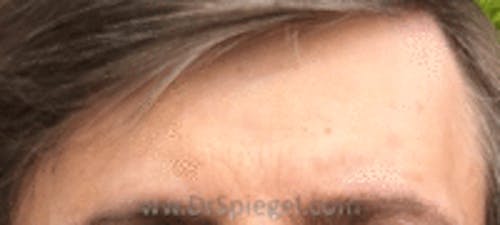 Brow Lift / Fox Eye Lift Before & After Gallery - Patient 425402 - Image 2