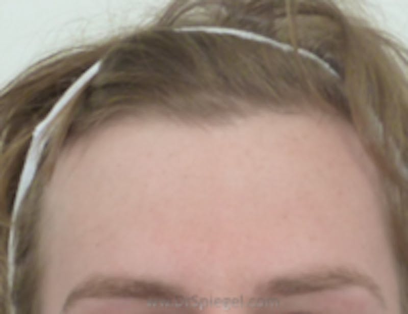 Browlift / Fox Eye Lift Before & After Gallery - Patient 396254 - Image 1