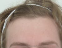 Brow Lift / Fox Eye Lift Before & After Gallery - Patient 396254 - Image 1