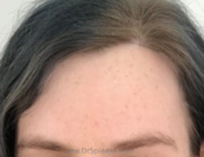 Browlift / Fox Eye Lift Before & After Gallery - Patient 396254 - Image 2