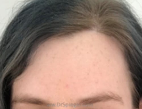 Brow Lift / Fox Eye Lift Before & After Gallery - Patient 396254 - Image 2