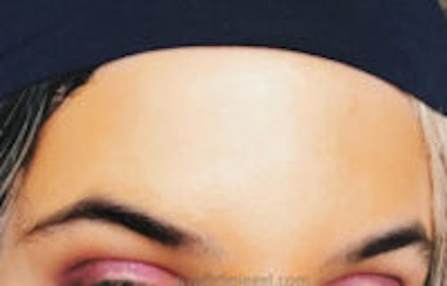 Brow Lift / Fox Eye Lift Before & After Gallery - Patient 478735 - Image 2