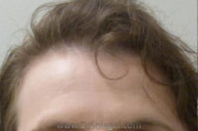 Browlift / Fox Eye Lift Before & After Gallery - Patient 232250 - Image 1