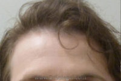 Browlift / Fox Eye Lift Before & After Gallery - Patient 232250 - Image 1