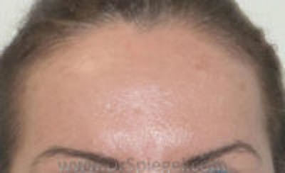 Browlift / Fox Eye Lift Before & After Gallery - Patient 371463 - Image 1