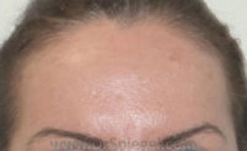 Brow Lift / Fox Eye Lift Before & After Gallery - Patient 371463 - Image 1