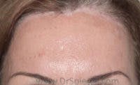 Brow Lift / Fox Eye Lift Before & After Gallery - Patient 371463 - Image 2