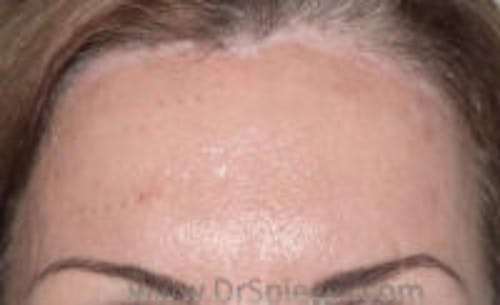 Brow Lift / Fox Eye Lift Before & After Gallery - Patient 371463 - Image 2