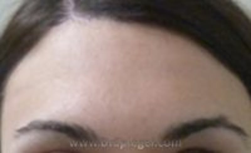 Browlift / Fox Eye Lift Before & After Gallery - Patient 321186 - Image 1