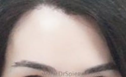 Brow Lift / Fox Eye Lift Before & After Gallery - Patient 321186 - Image 2