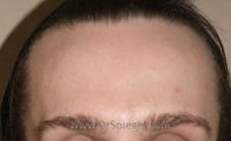 Browlift / Fox Eye Lift Before & After Gallery - Patient 327322 - Image 1