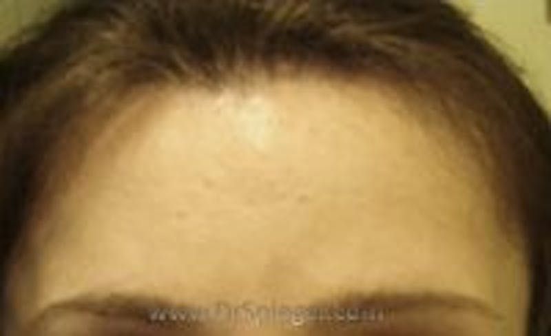 Browlift / Fox Eye Lift Before & After Gallery - Patient 327322 - Image 2