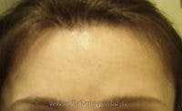 Brow Lift / Fox Eye Lift Before & After Gallery - Patient 327322 - Image 2