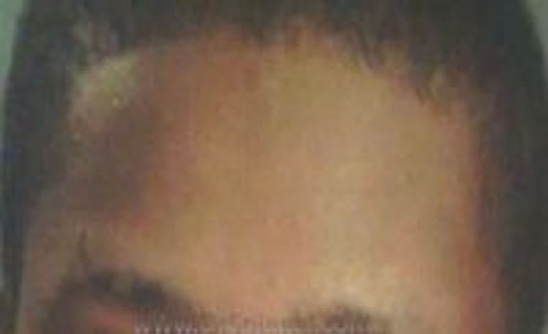 Browlift / Fox Eye Lift Before & After Gallery - Patient 437316 - Image 1