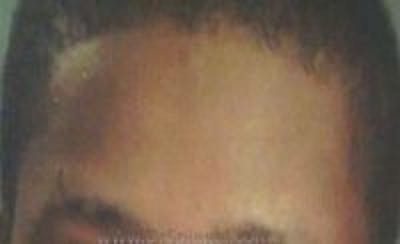 Browlift / Fox Eye Lift Before & After Gallery - Patient 437316 - Image 1