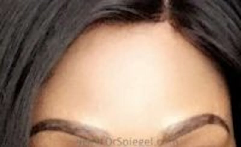 Browlift / Fox Eye Lift Before & After Gallery - Patient 437316 - Image 2