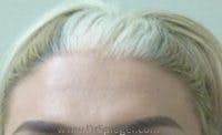 Brow Lift / Fox Eye Lift Before & After Gallery - Patient 251130 - Image 1