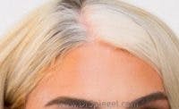 Brow Lift / Fox Eye Lift Before & After Gallery - Patient 251130 - Image 2