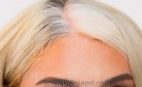 Brow Lift / Fox Eye Lift Before & After Gallery - Patient 251130 - Image 2
