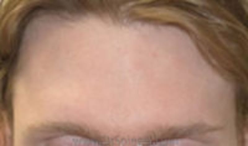 Browlift / Fox Eye Lift Before & After Gallery - Patient 125842 - Image 1