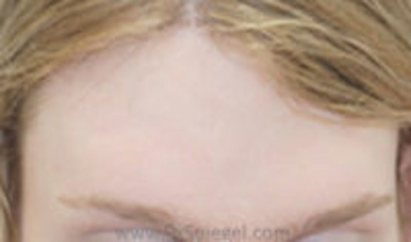 Browlift / Fox Eye Lift Before & After Gallery - Patient 125842 - Image 2