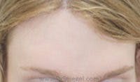 Brow Lift / Fox Eye Lift Before & After Gallery - Patient 125842 - Image 2