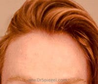Brow Lift / Fox Eye Lift Before & After Gallery - Patient 148114 - Image 1