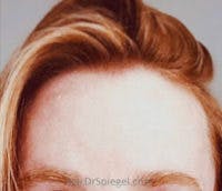 Brow Lift / Fox Eye Lift Before & After Gallery - Patient 148114 - Image 2