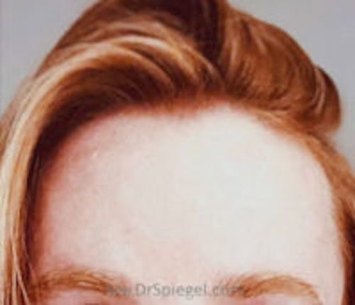 Brow Lift / Fox Eye Lift Before & After Gallery - Patient 148114 - Image 2