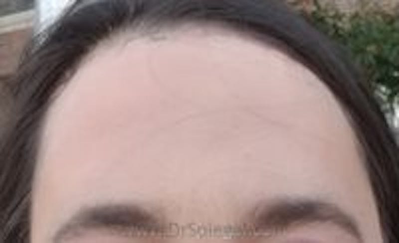 Browlift / Fox Eye Lift Before & After Gallery - Patient 111128 - Image 2