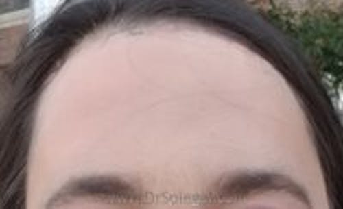 Brow Lift / Fox Eye Lift Before & After Gallery - Patient 111128 - Image 2