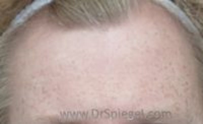 Browlift / Fox Eye Lift Before & After Gallery - Patient 305907 - Image 1