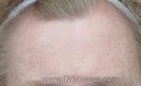 Brow Lift / Fox Eye Lift Before & After Gallery - Patient 305907 - Image 1