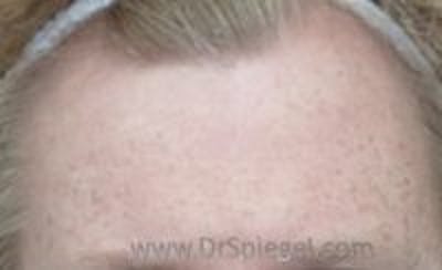 Browlift / Fox Eye Lift Before & After Gallery - Patient 305907 - Image 1