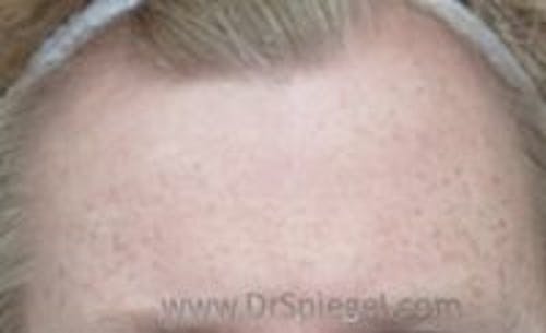 Brow Lift / Fox Eye Lift Before & After Gallery - Patient 305907 - Image 1