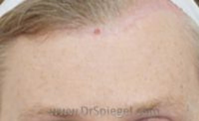 Browlift / Fox Eye Lift Before & After Gallery - Patient 305907 - Image 2
